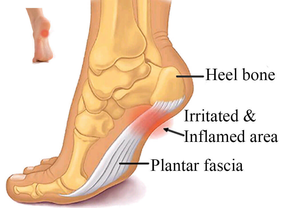 heel bone pain